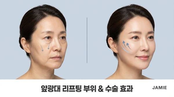 앞광대 리프팅이 왜 필요할까?