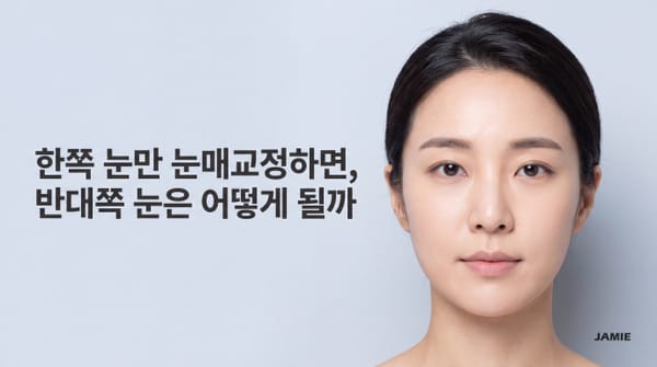 헤링의 법칙과 짝눈 교정 — 눈매교정 한쪽만 가능할까